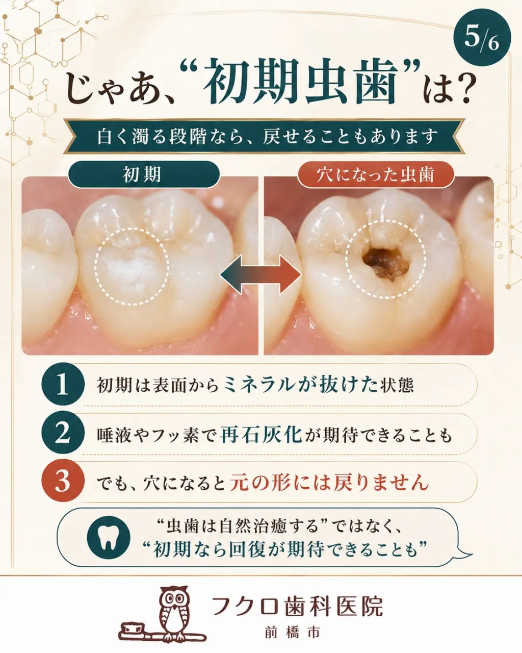 「骨は折れても治るのに、虫歯はなぜ元に戻らないの？」
