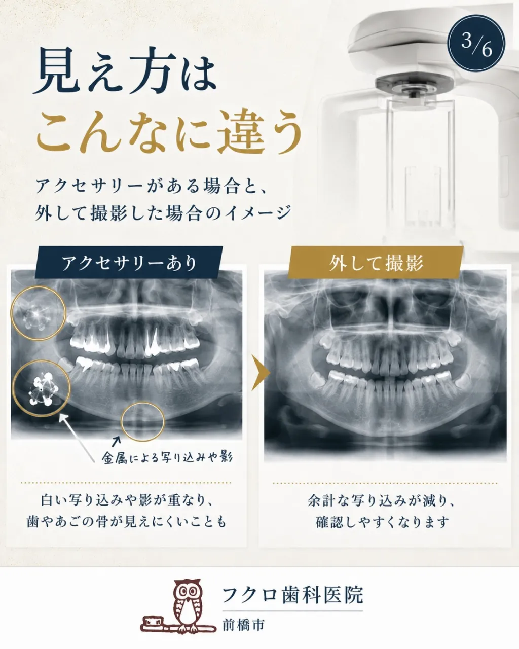 「歯のレントゲンなのに、ネックレスやピアスまで外すの?」